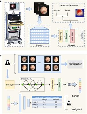 Deep learning for real-time detection of breast cancer presenting pathological nipple discharge by ductoscopy